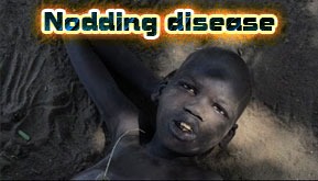 Nodding disease