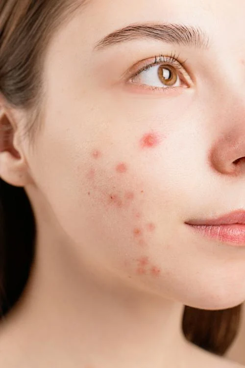Say Yes To Supplements And Goodbye To Acne